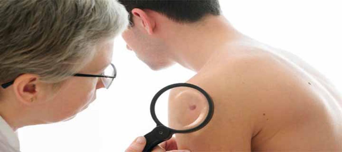 Moles on your arms can indicate skin cancer risk